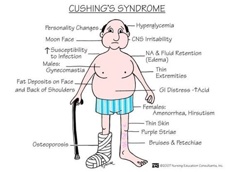 cushing's syndrome cks